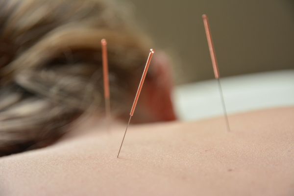 Wie schnell wirkt Akupunktur?
